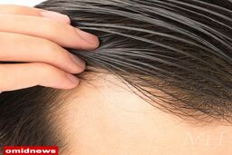 درمان خانگی چرب شدن موی سر + علت و علائم و روش های پیشگیری از آن