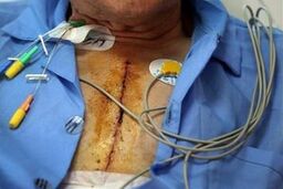 انتقاد از بهزیستی، که بیماران هموفیلی را معلول نمی شناسد