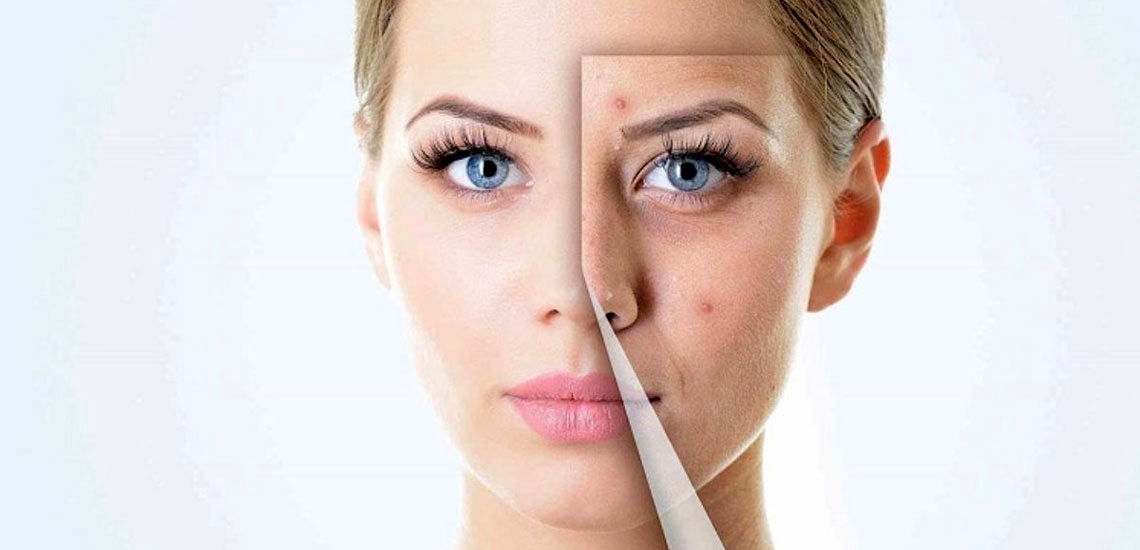 پاک شدن جای جوش با چند ترفند حرفه ای + معرفی 4 ماده در دسترس دشمن جوش