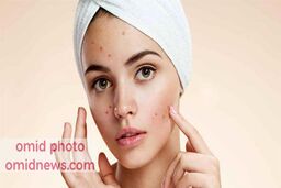 چرا جوش میزنیم
