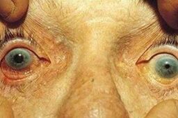 ۸۰۰ هزار ایرانی به آب سیاه مبتلا هستند + توصیه ها