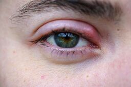 عوارض گل مژه چشم ؛ معرفی سریع ترین درمان گل مژه
