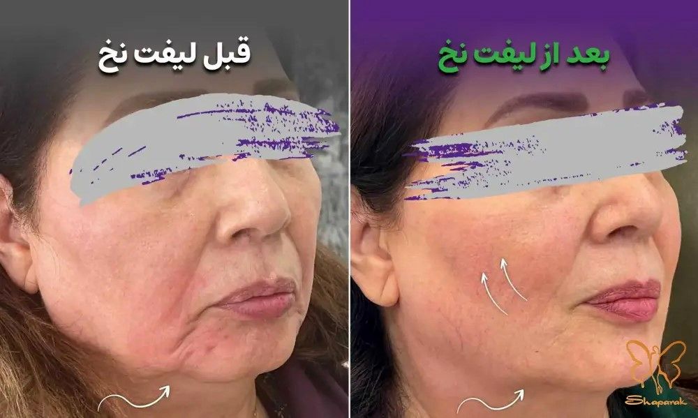 معجزه لیفت صورت با نخ های سیلوئت آمریکایی