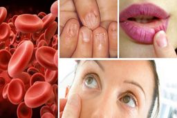 شایع ترین علائم کم خونی یا فقر آهن و راه های درمان آن را بشناسید