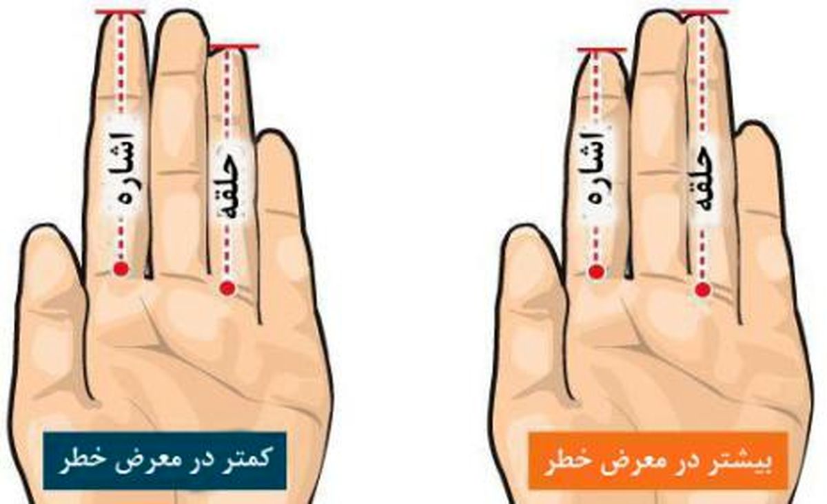 مطالعه طول انگشتان دست برای بررسی خطر ابتلا به سرطان پروستات