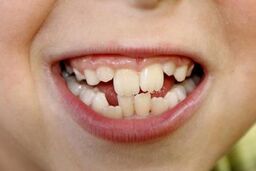 ماجرای ۳۲ و کج شدن دندان ها؛ پای مغز در میان است