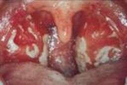 مفاهیم: منونوکلئوز چیست؟